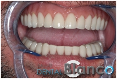 Quistes e Implantes Salud dental Blanco