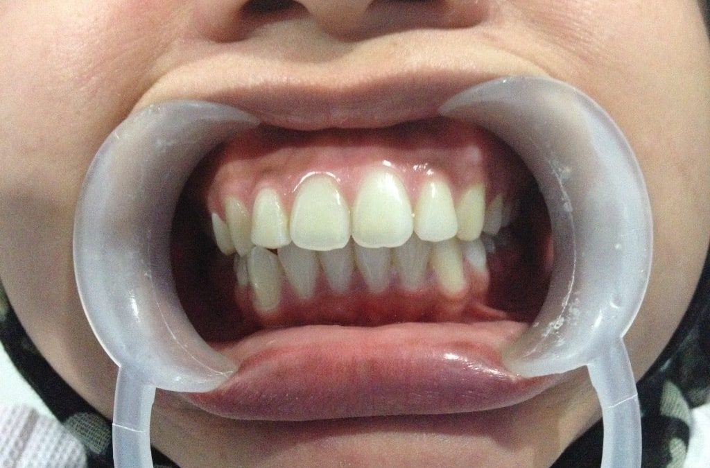 Encías blancas, 5 causas que las provocan