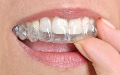 5 Tipos de férula dental: conoce sus funciones