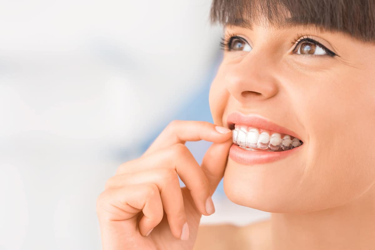 Invisalign: las preguntas más frecuentes sobre la ortodoncia invisible