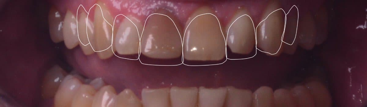 Diseño digital de sonrisa dientes