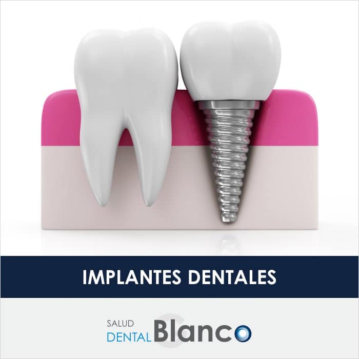 Implantes Dentales Madrid