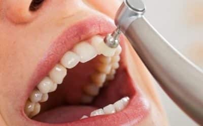 ¿Desgastan los dientes las limpiezas dentales?