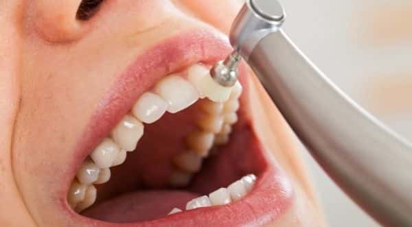 Desgastan los dientes las limpiezas dentales