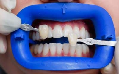 Tipos de carillas estéticas dentales y sus materiales