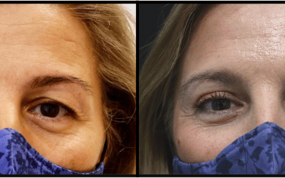Antes y después de una cirugía de Blefaroplastia.