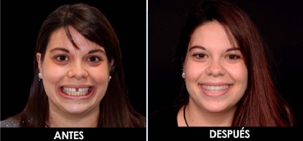 Ortodoncia. Antes y después.