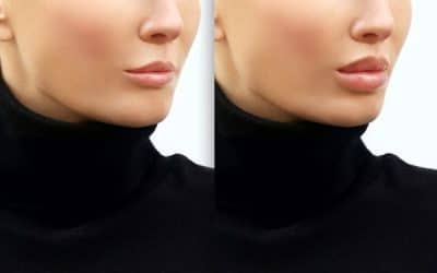 Cómo es el antes y después del aumento de labios
