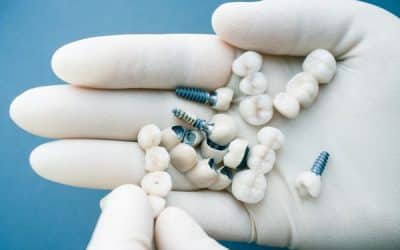 Qué son y cómo se colocan los mini implantes dentales