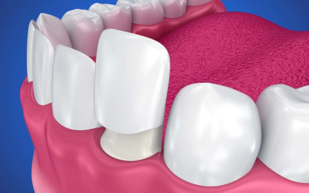 Carillas dentales de porcelana. Lo que necesitas saber