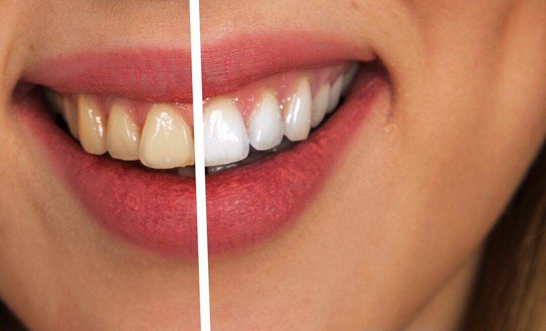 Limpieza dental con aeropulidor de bicarbonato ¿En qué consiste?