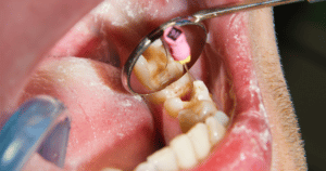 Caries no tratada endodoncia