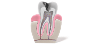 endodoncia y caries