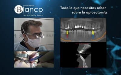 Todo lo que necesitas saber sobre la apicectomía