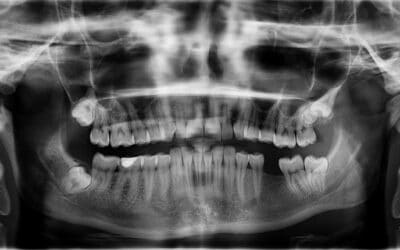 Lo que debes saber sobre la radiografía dental: Beneficios y riesgos