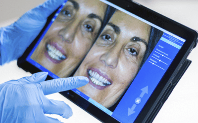 Dentadura fija sobre implantes: ventajas, procedimiento y qué opción elegir