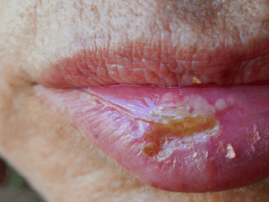 Herpes en el labio