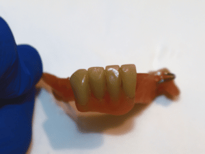 Pérdida de hueso dental por el uso de prótesis removible
