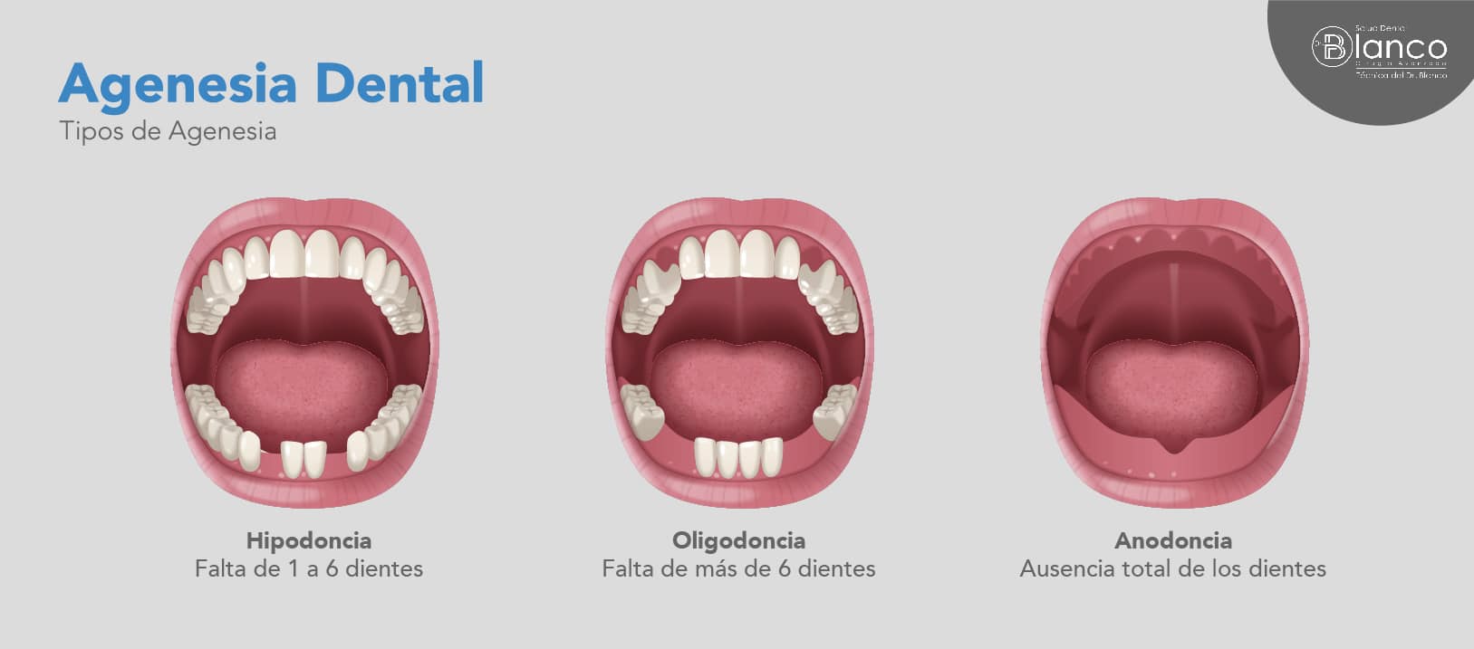 Agenesia Dental Tratamientos