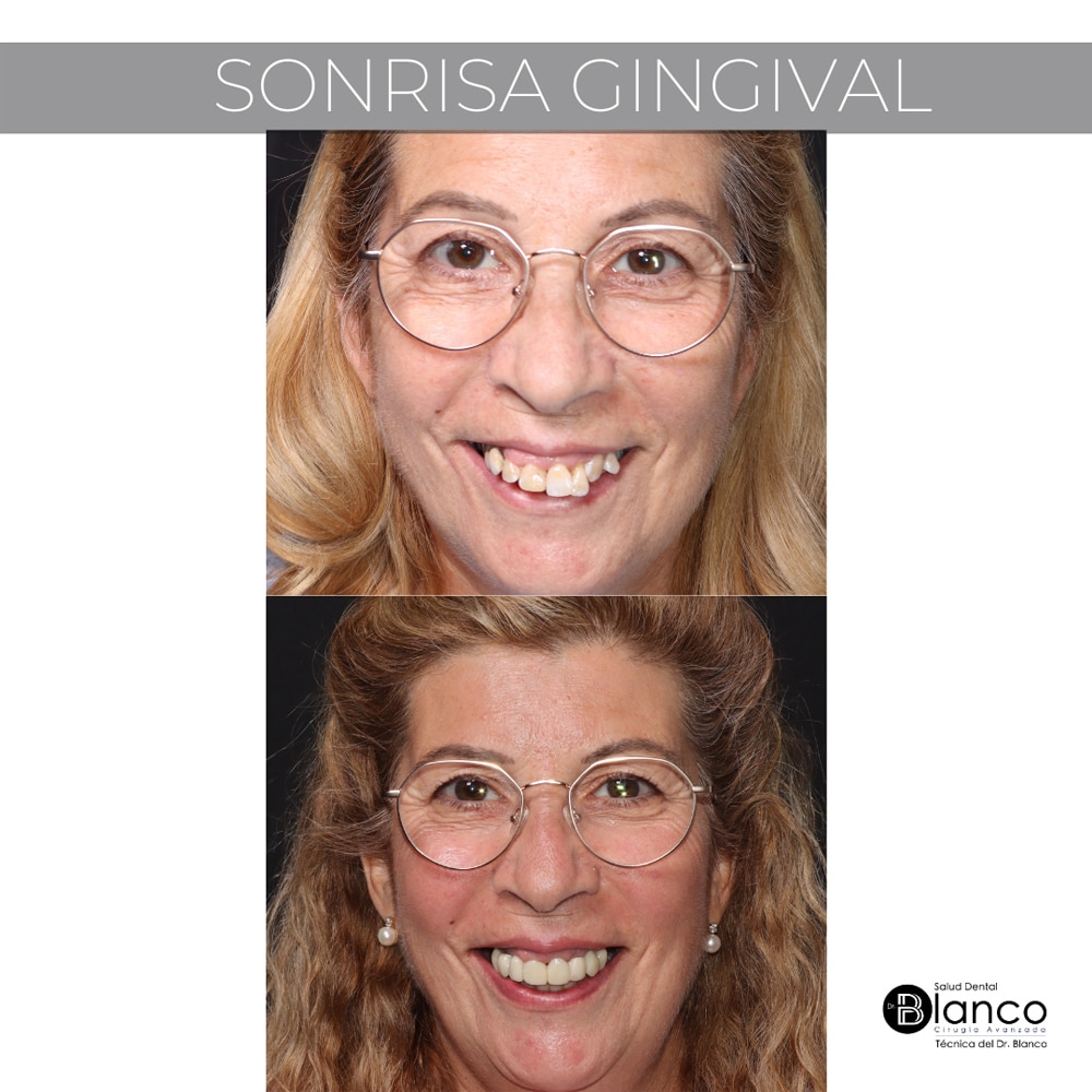 Sonrisa Gingival Antes y después