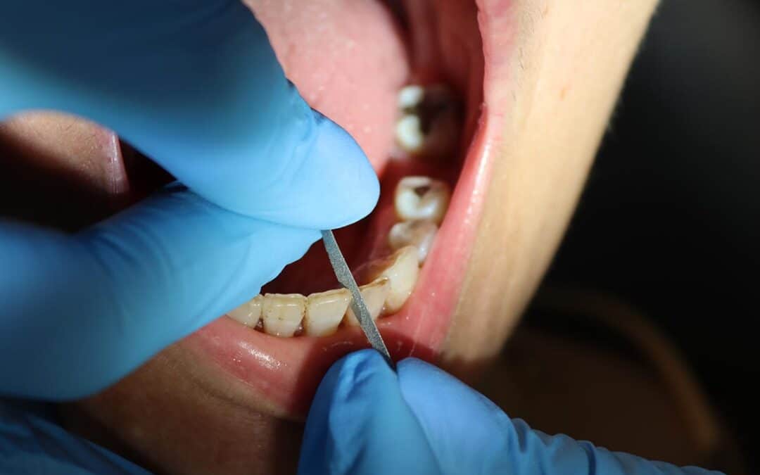 Stripping dental