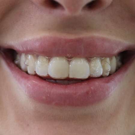 Fotografía real de ortodoncia invisible