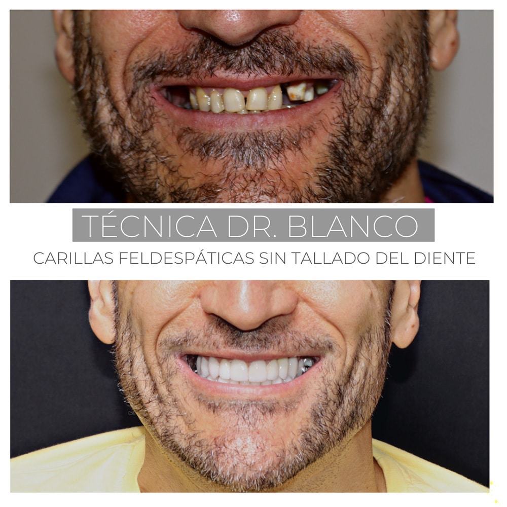 Carillas sin tallar diente Madrid antes y después