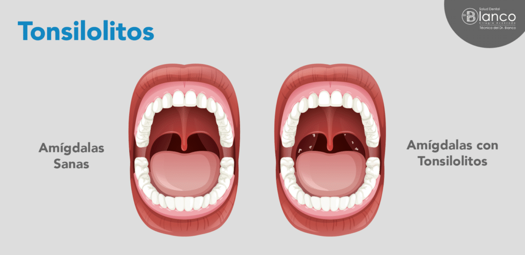 Amígdalas con tonsilolitos