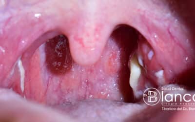Qué son los tonsilolitos