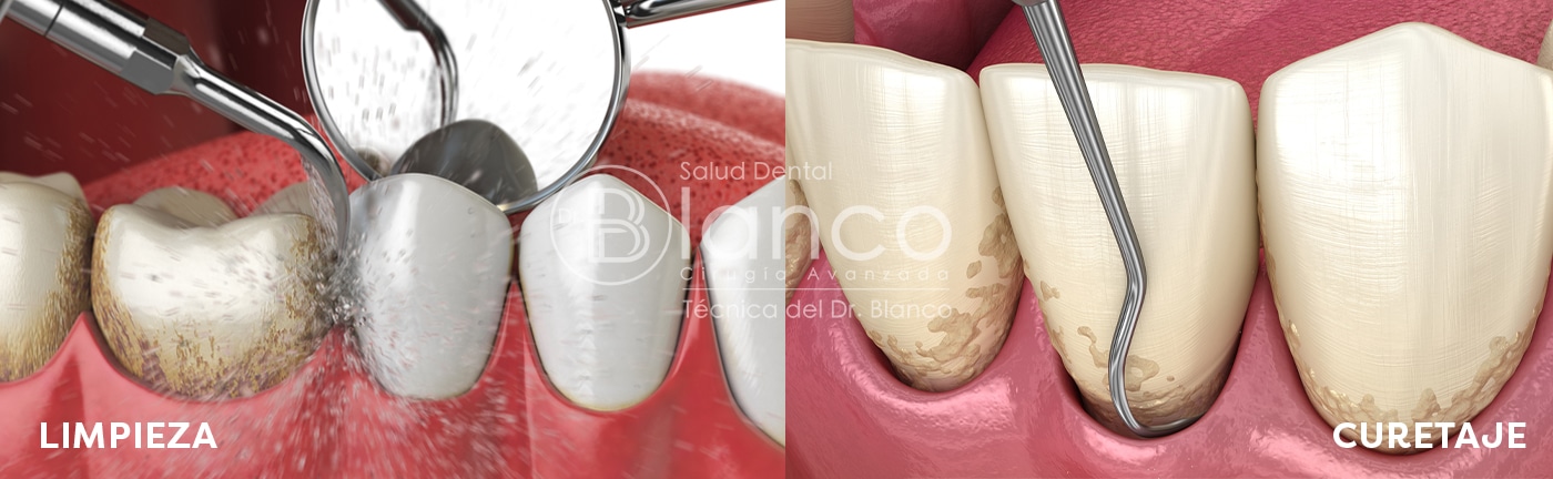 Diferencia entre limpieza dental y curetaje