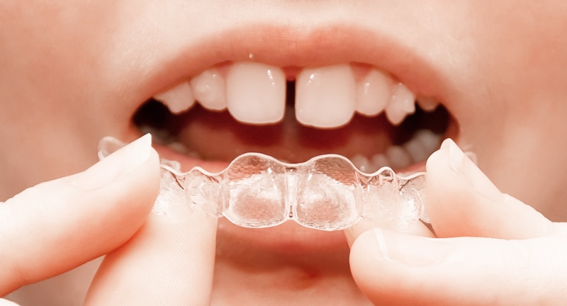 Diastema dental Invisalign
