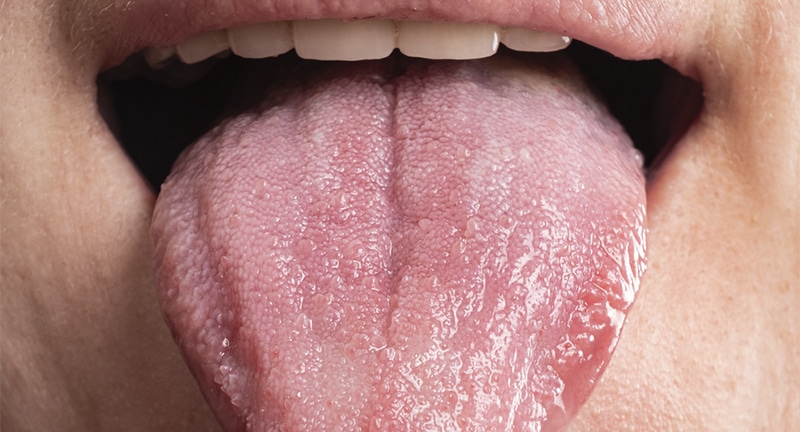 Lesiones de la lengua quemada