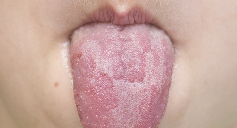 Lesiones de la lengua lengua escaldada