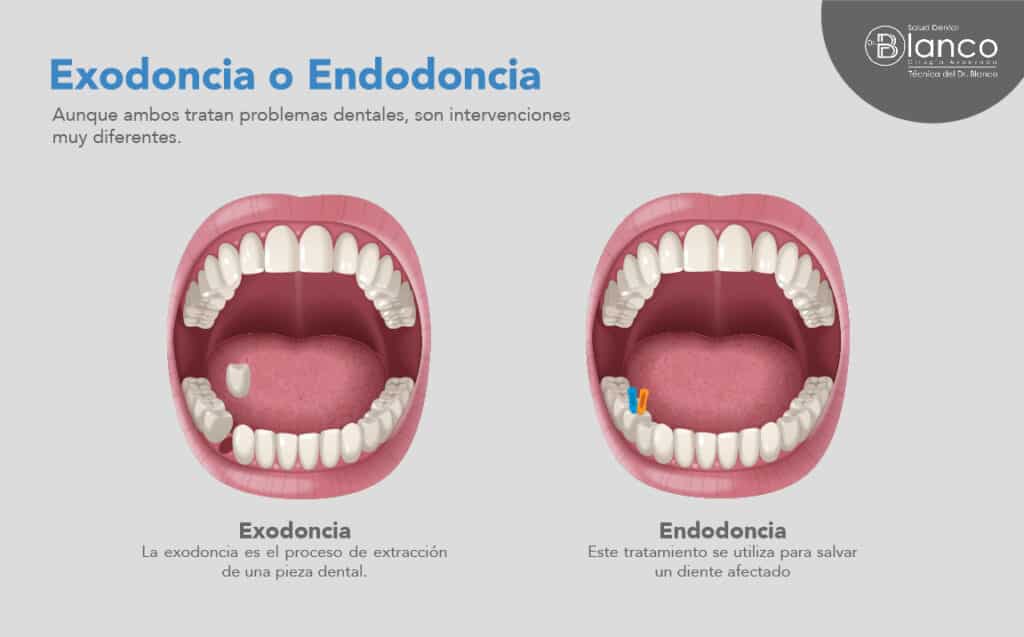 Diferencia entre exodoncia y endodoncia