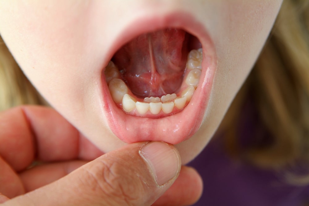 Diente ectópico - ortodoncia en niños con dientes de tiburón