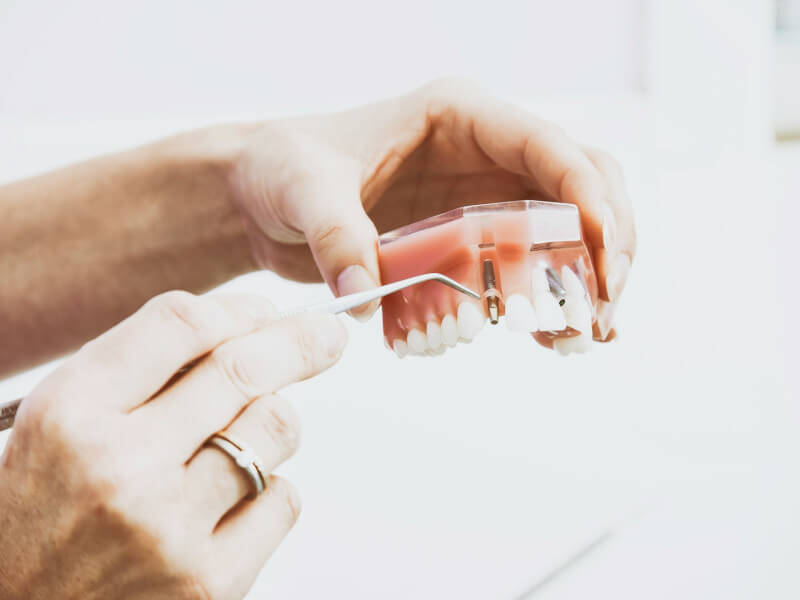 carga inmediata vs. implantes tradicionales