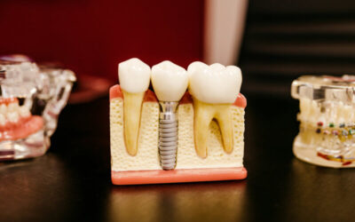 Tipos de implantes dentales: cuál necesitas según tu caso