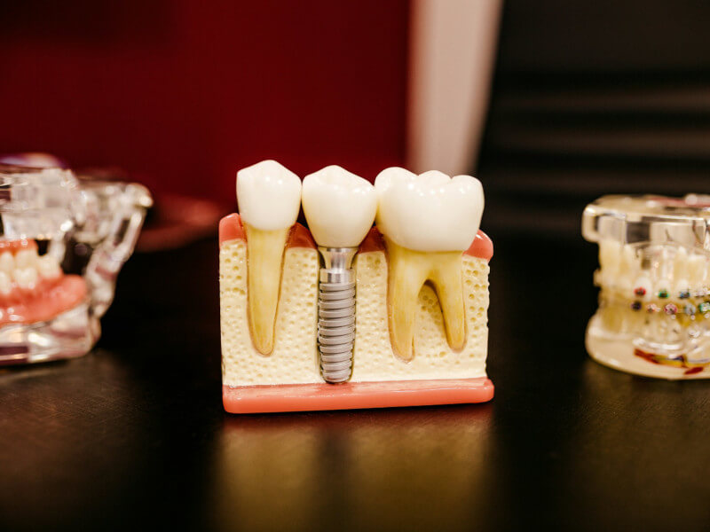 manual implantes dentales manual implantes dentales