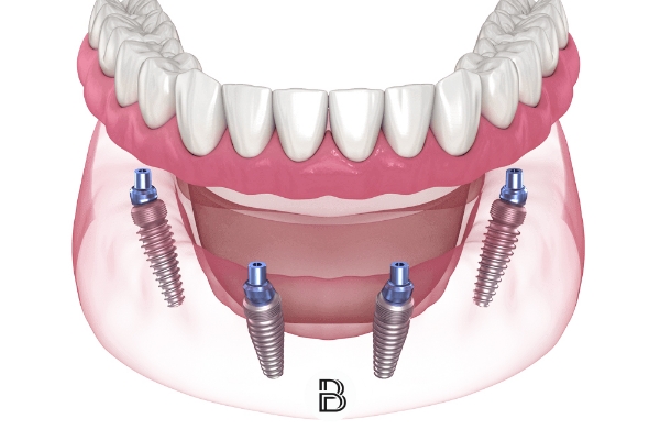 Implantes de carga inmediata en Salud Dental Blanco