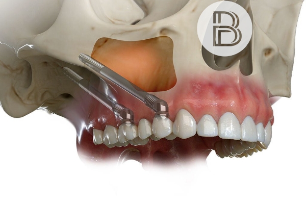 Implantes cigomáticos en Madrid
