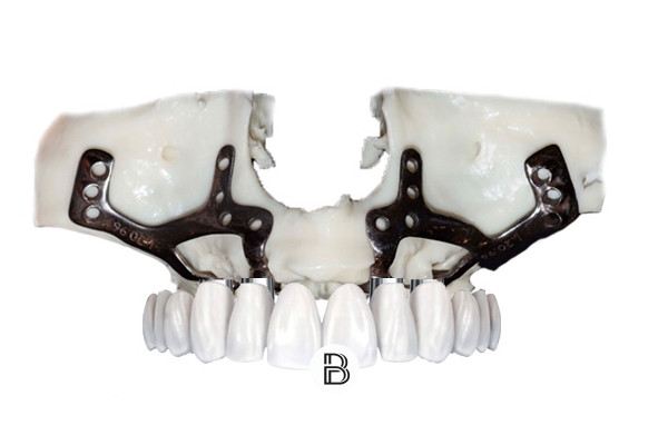 Implantes corticales en Madrid