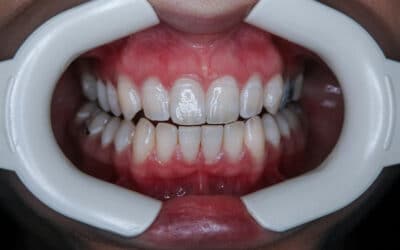 Cómo blanquear los dientes de forma segura y efectiva
