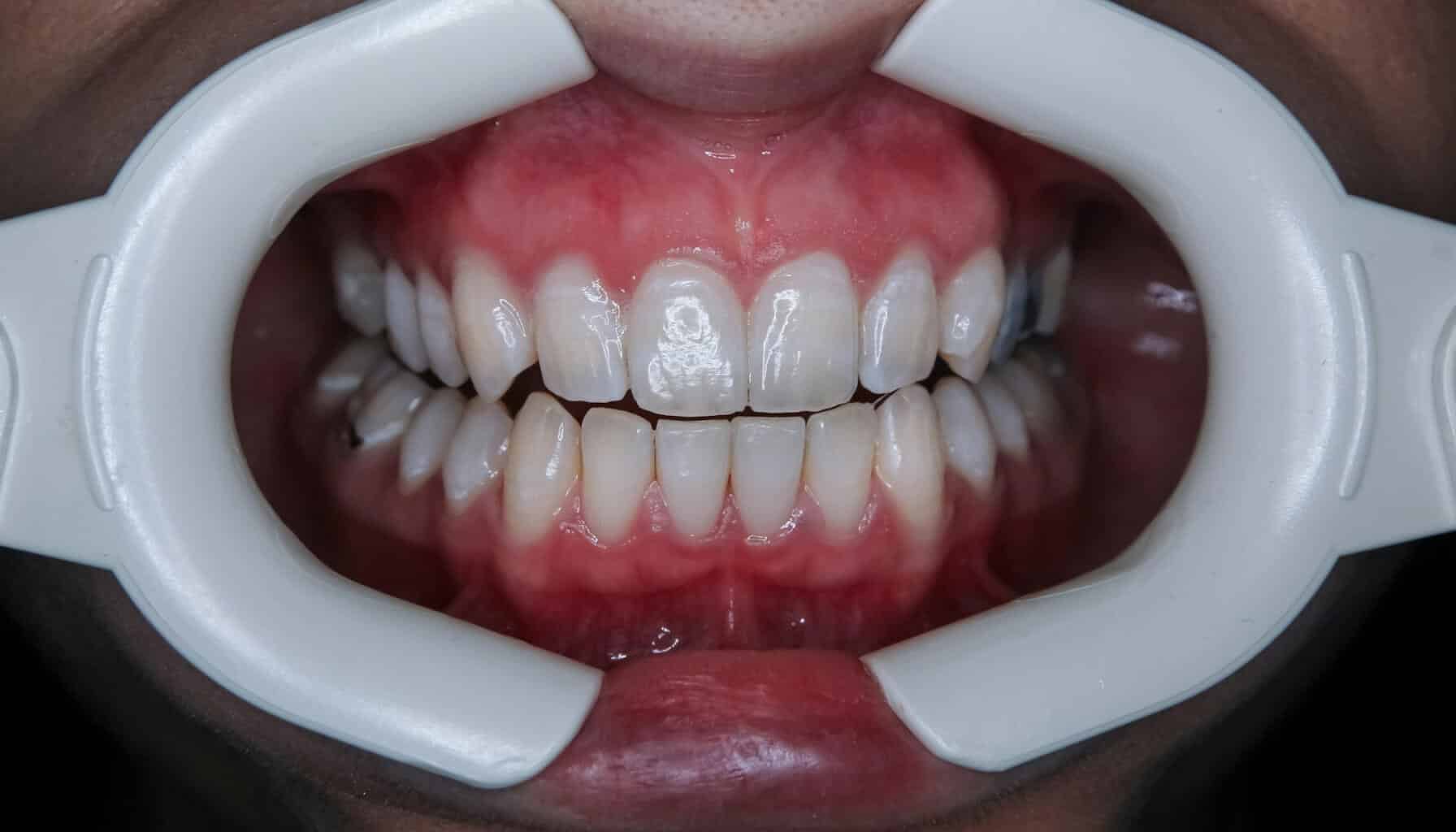 como blanquear lo dientes como blanquear lo dientes