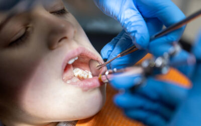 Cómo sé si tengo caries: síntomas y señales de alerta