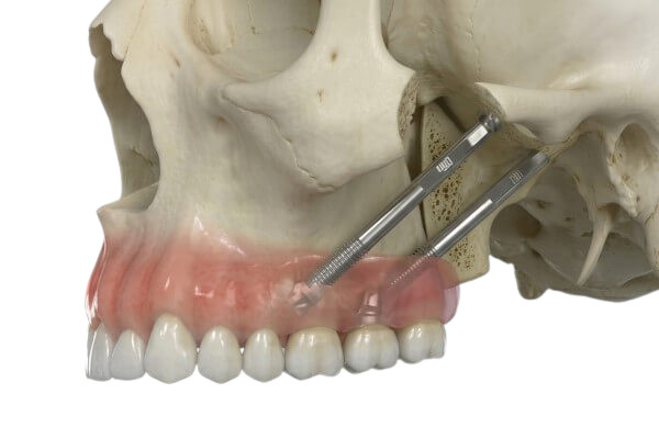 Implantes pterigoideos en Salud Dental Blanco
