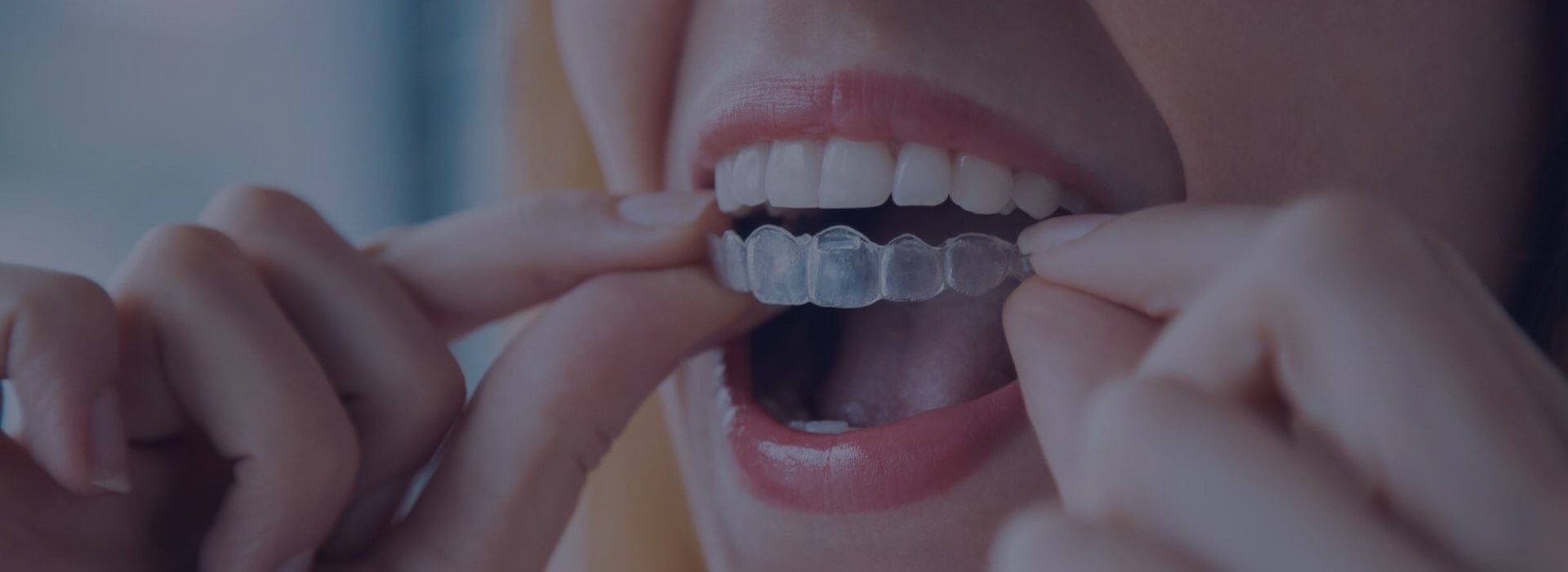 Ortodoncia en Madrid - Salud Dental Blanco