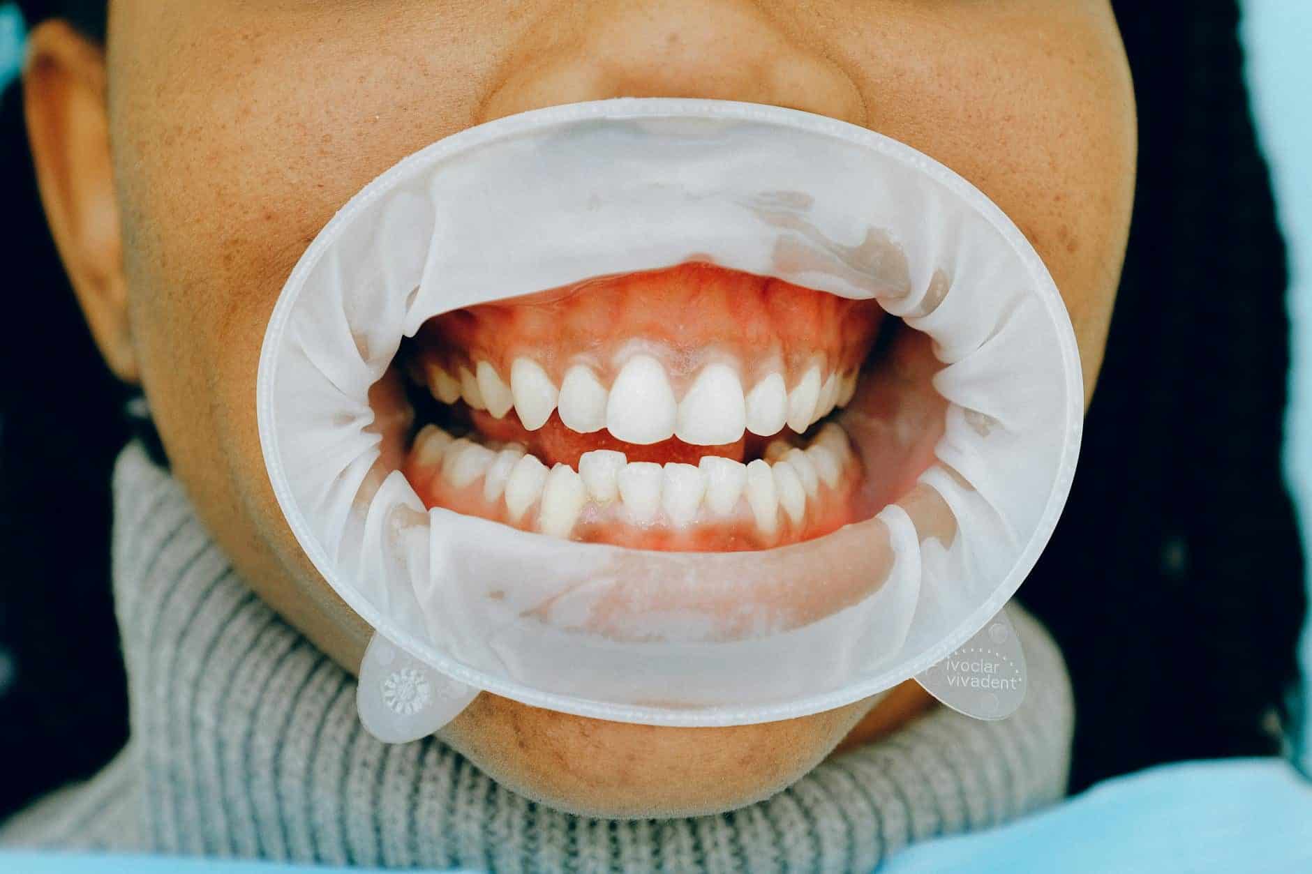 Síntomas de periodontitis - encías inflamadas Mujer con encías inflamadas — síntomas que indican curetaje