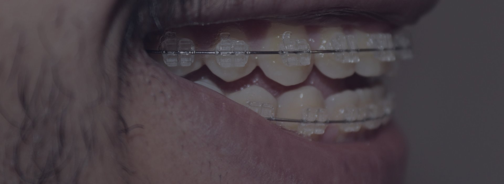 Ortodoncia en Salud Dental Blanco