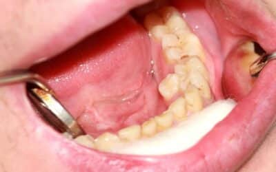 Qué son los dientes supernumerarios y cómo afectan a nuestra boca