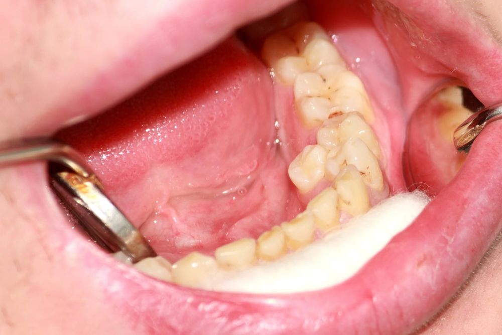 Dientes supernumerarios Dientes supernumerarios
